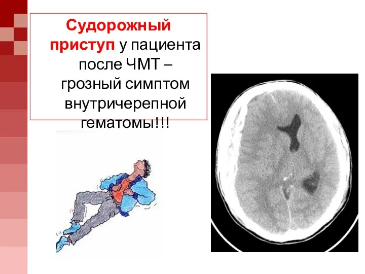 Судорожный приступ у пациента после ЧМТ – грозный симптом внутричерепной гематомы!!!