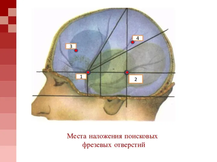 Места наложения поисковых фрезевых отверстий 1 2 3 4