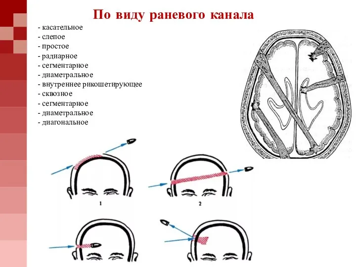 По виду раневого канала - касательное - слепое - простое - радиарное