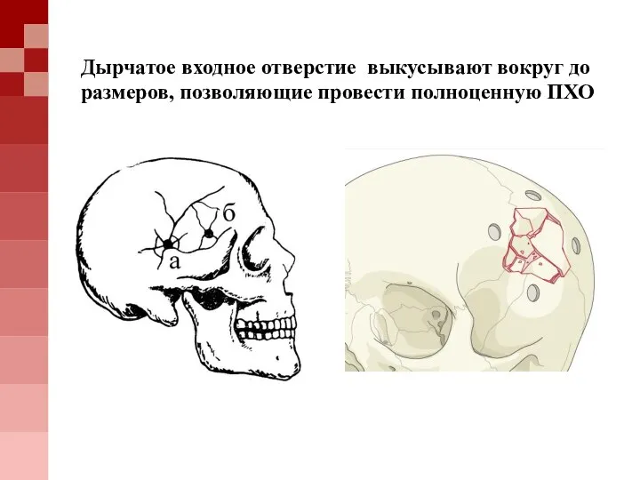 Дырчатое входное отверстие выкусывают вокруг до размеров, позволяющие провести полноценную ПХО