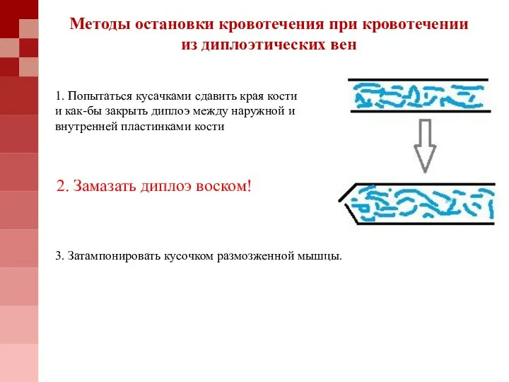 1. Попытаться кусачками сдавить края кости и как-бы закрыть диплоэ между наружной