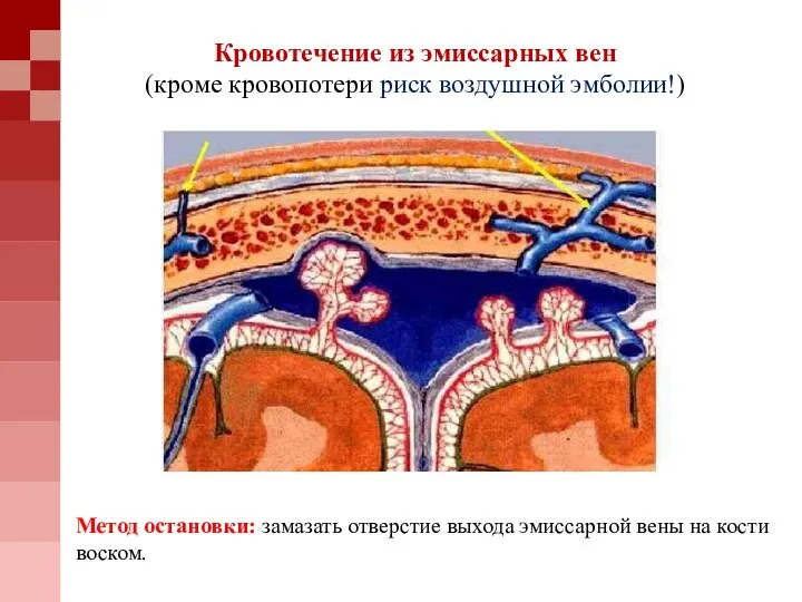 Кровотечение из эмиссарных вен (кроме кровопотери риск воздушной эмболии!) Метод остановки: замазать