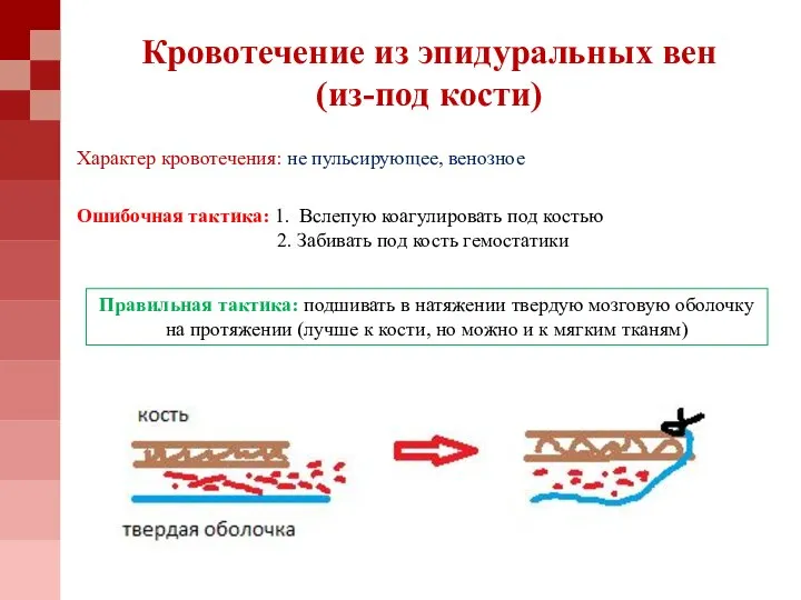 Кровотечение из эпидуральных вен (из-под кости) Ошибочная тактика: 1. Вслепую коагулировать под