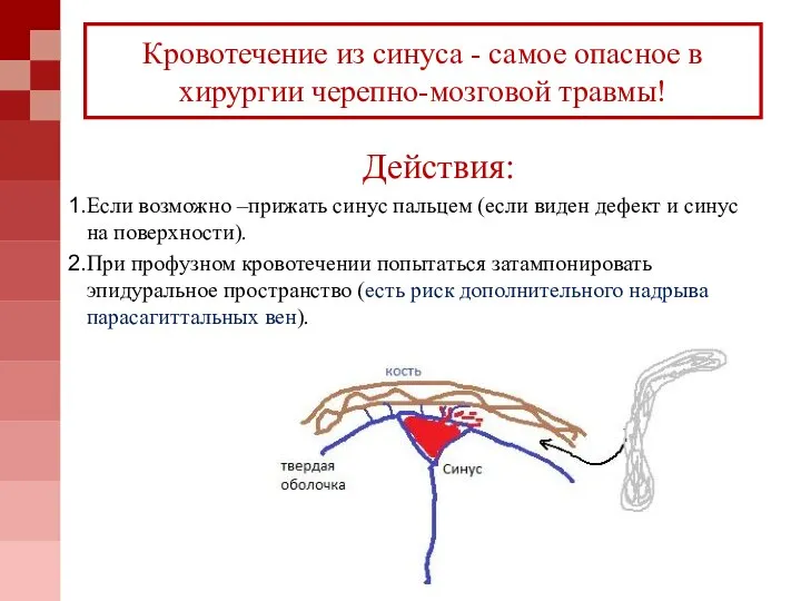 Кровотечение из синуса - самое опасное в хирургии черепно-мозговой травмы! Действия: Если