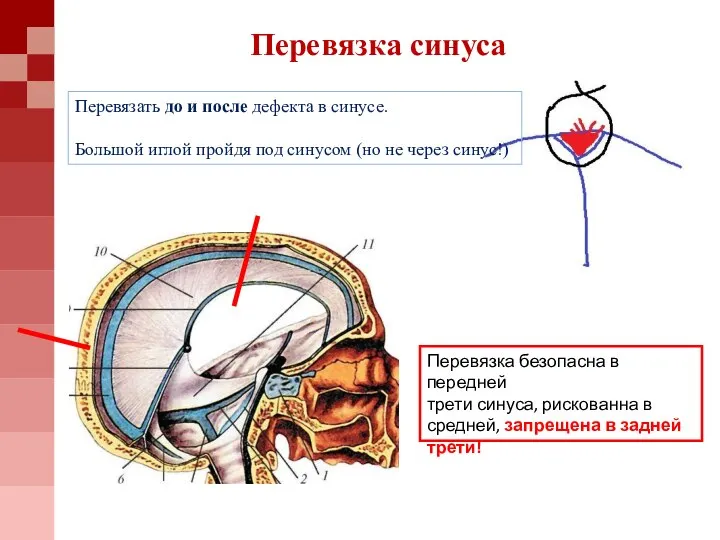 Перевязка синуса Перевязать до и после дефекта в синусе. Большой иглой пройдя