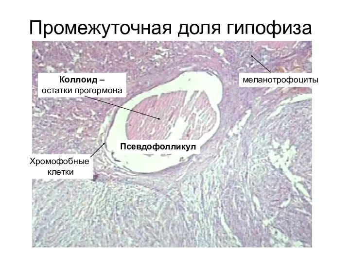 Промежуточная доля гипофиза Псевдофолликул Коллоид – остатки прогормона меланотрофоциты Хромофобные клетки