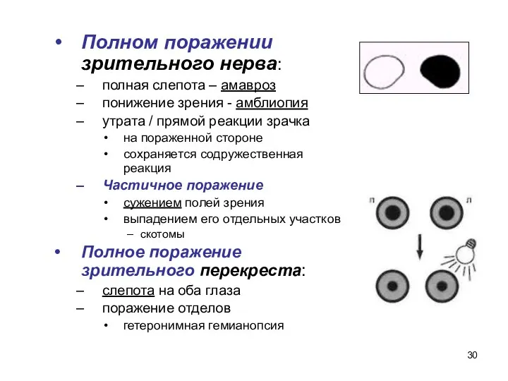 Полном поражении зрительного нерва: полная слепота – амавроз понижение зрения - амблиопия