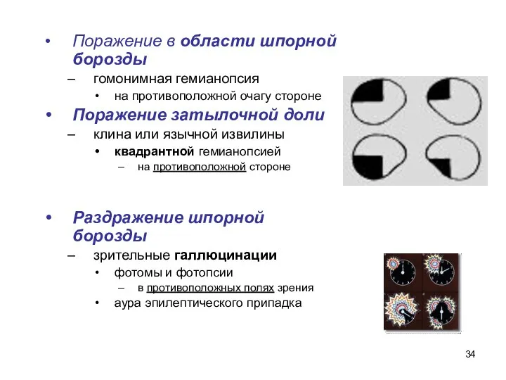 Поражение в области шпорной борозды гомонимная гемианопсия на противоположной очагу стороне Поражение