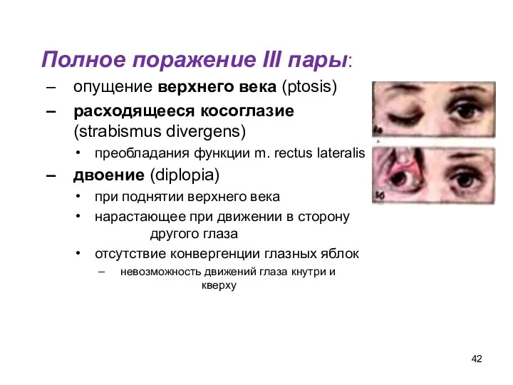 Полное поражение III пары: опущение верхнего века (ptosis) расходящееся косоглазие (strabismus divergens)