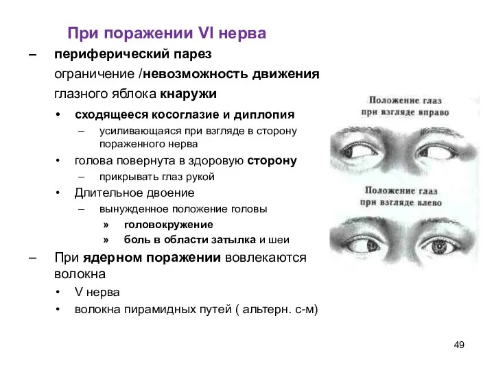 При поражении VI нерва периферический парез ограничение /невозможность движения глазного яблока кнаружи