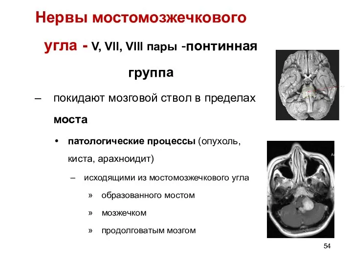 Нервы мостомозжечкового угла - V, VII, VIII пары -понтинная группа покидают мозговой