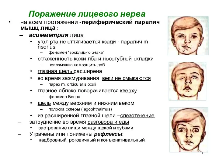 Поражение лицевого нерва на всем протяжении -периферический паралич мышц лица : асимметрия