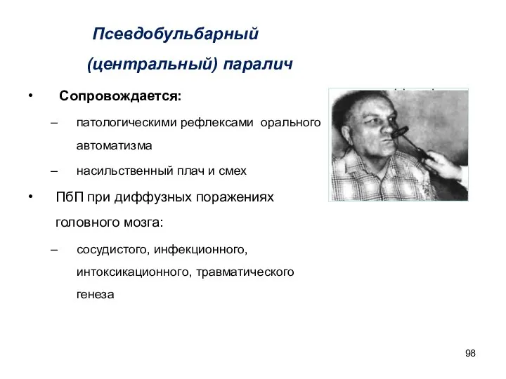 Псевдобульбарный (центральный) паралич Сопровождается: патологическими рефлексами орального автоматизма насильственный плач и смех