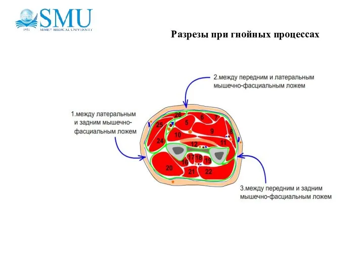 Разрезы при гнойных процессах