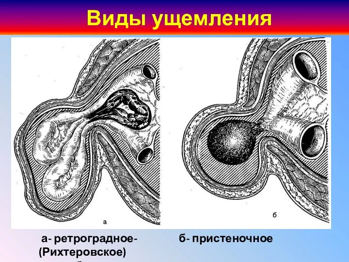 Виды ущемления а- ретроградное- б- пристеночное (Рихтеровское) W-образное