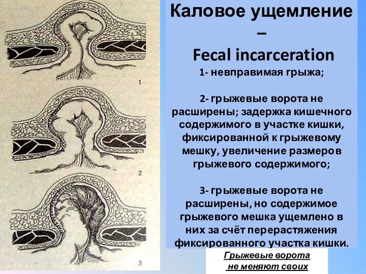 Каловое ущемление – Fecal incarceration 1- невправимая грыжа; 2- грыжевые ворота не