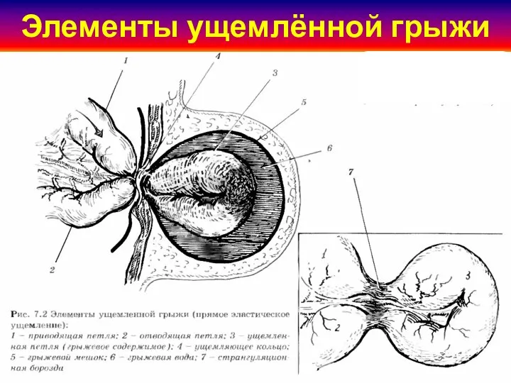 Элементы ущемлённой грыжи