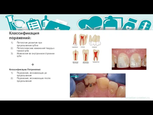 Классификация поражений: Патология развития при прорезывании зубов Патологические изменения твердых тканей зуба