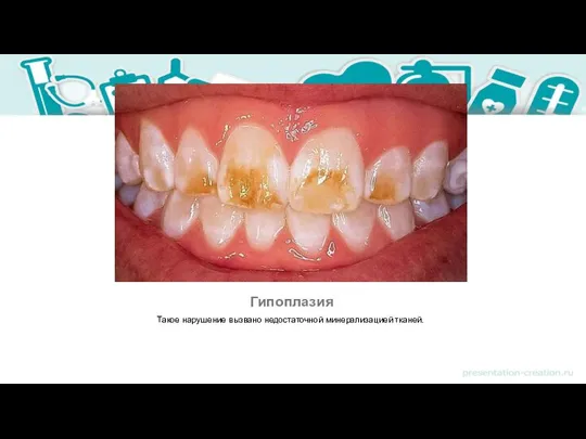 Гипоплазия Такое нарушение вызвано недостаточной минерализацией тканей.