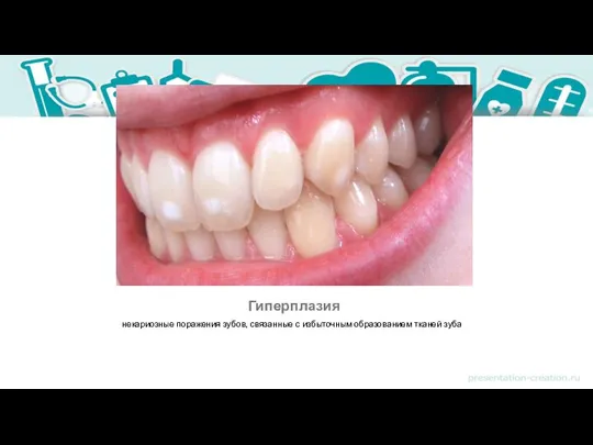 Гиперплазия некариозные поражения зубов, связанные с избыточным образованием тканей зуба