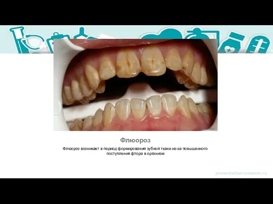 Флюороз Флюороз возникает в период формирования зубной ткани из-за повышенного поступления фтора в организм