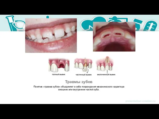 Травмы зубов Понятие «травма зубов» объединяет в себе повреждения механического характера внешних или внутренних частей зуба.