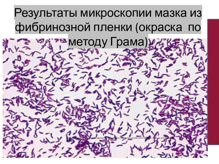 Результаты микроскопии мазка из фибринозной пленки (окраска по методу Грама) https://microbe-canvas.com/uploads/image/bacterien/corynebacterium-diphtheriae/corynebacterium-diphteriae_cor48_cult_gram-3_f-350x220.jpg