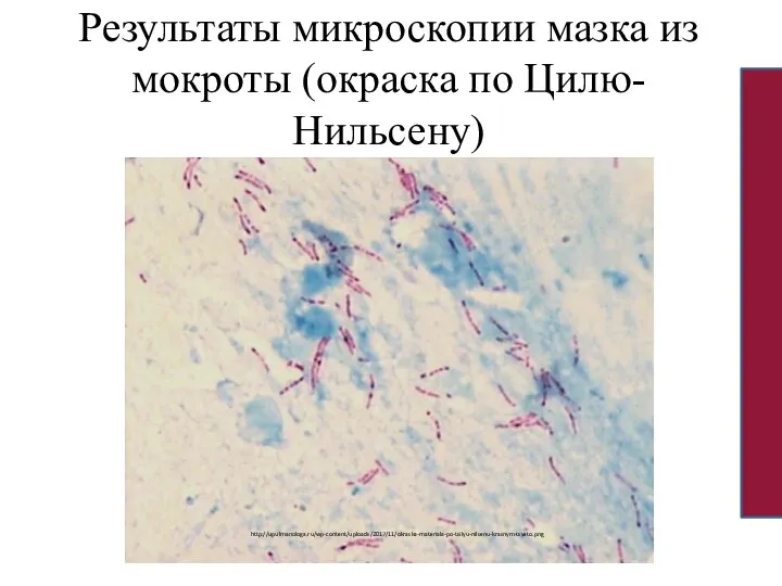 Результаты микроскопии мазка из мокроты (окраска по Цилю-Нильсену) http://upulmanologa.ru/wp-content/uploads/2017/11/okraska-materiala-po-tsilyu-nilsenu-krasnym-tsveto.png