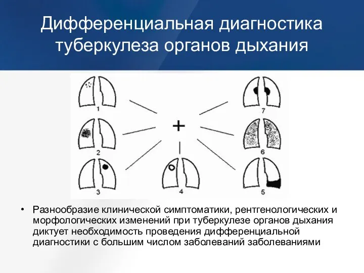 Дифференциальная диагностика туберкулеза органов дыхания Разнообразие клинической симптоматики, рентгенологических и морфологических изменений