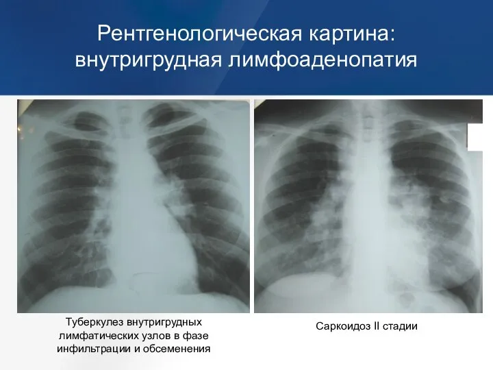 Рентгенологическая картина: внутригрудная лимфоаденопатия Туберкулез внутригрудных лимфатических узлов в фазе инфильтрации и обсеменения Саркоидоз II стадии