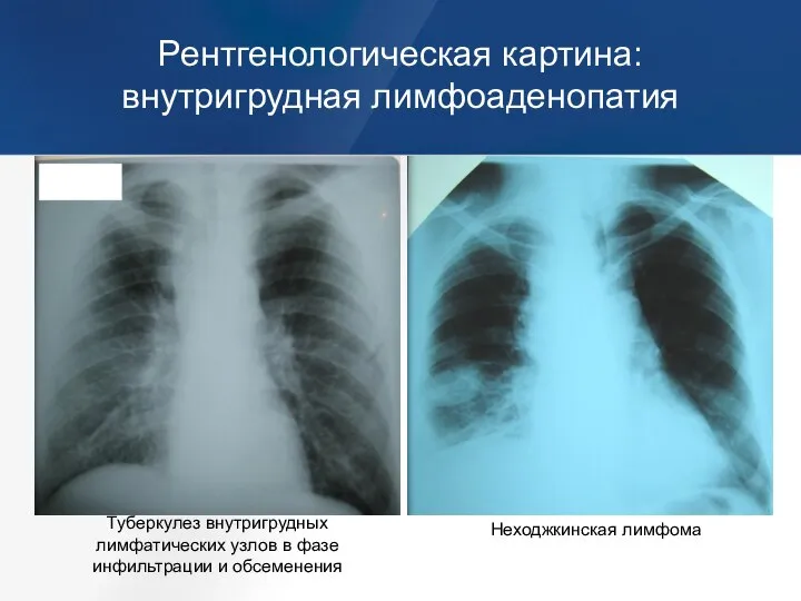 Рентгенологическая картина: внутригрудная лимфоаденопатия Туберкулез внутригрудных лимфатических узлов в фазе инфильтрации и обсеменения Неходжкинская лимфома