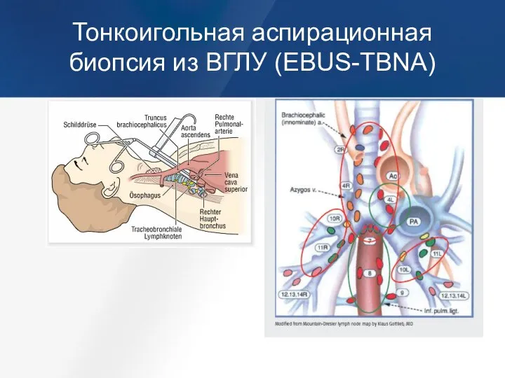 Тонкоигольная аспирационная биопсия из ВГЛУ (EBUS-TBNA)