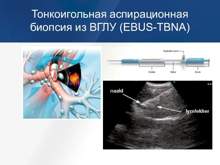 Тонкоигольная аспирационная биопсия из ВГЛУ (EBUS-TBNA)