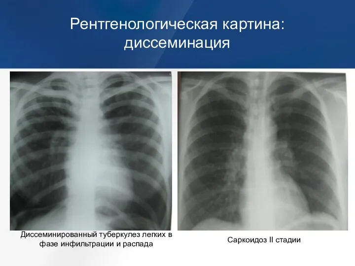 Рентгенологическая картина: диссеминация Диссеминированный туберкулез легких в фазе инфильтрации и распада Саркоидоз II стадии