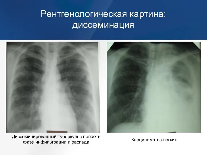 Рентгенологическая картина: диссеминация Диссеминированный туберкулез легких в фазе инфильтрации и распада Карциноматоз легких