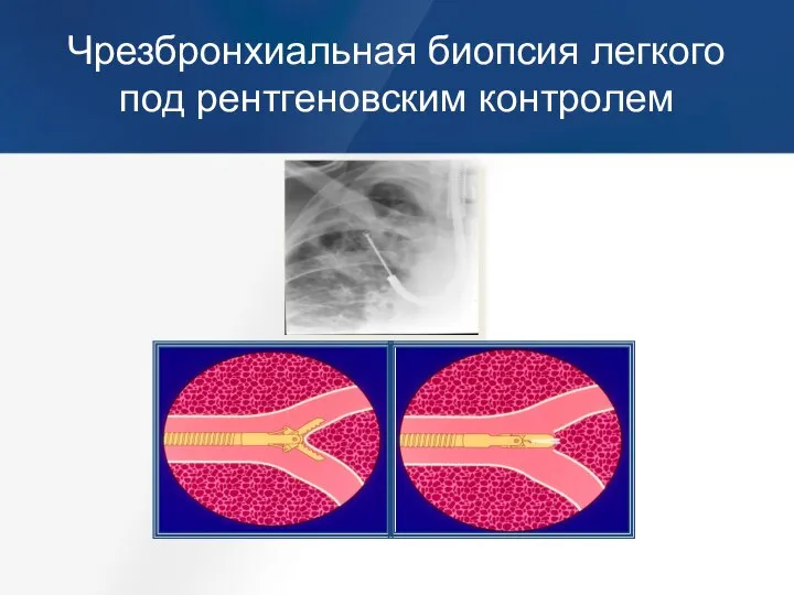 Чрезбронхиальная биопсия легкого под рентгеновским контролем