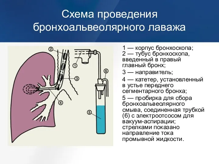 Схема проведения бронхоальвеолярного лаважа 1 — корпус бронхоскопа; 2 — тубус бронхоскопа,