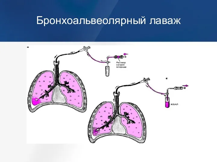 Бронхоальвеолярный лаваж