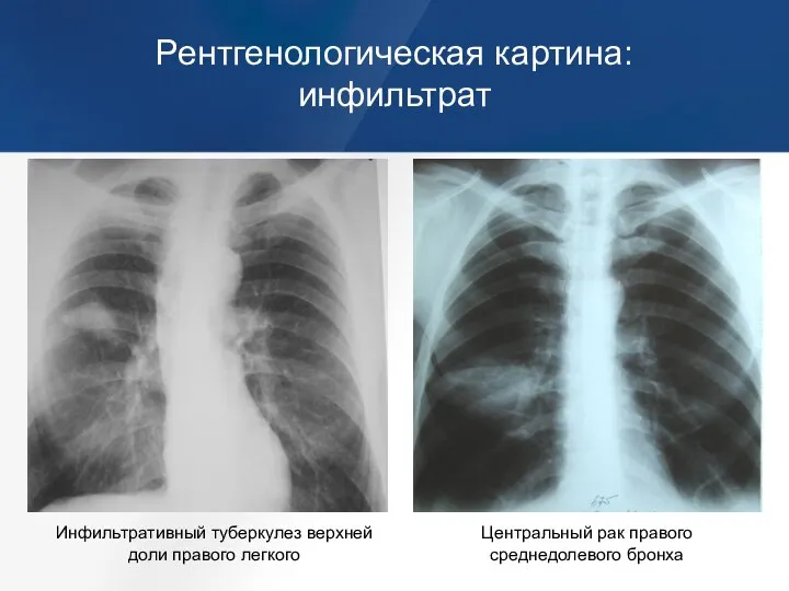 Рентгенологическая картина: инфильтрат Инфильтративный туберкулез верхней доли правого легкого Центральный рак правого среднедолевого бронха