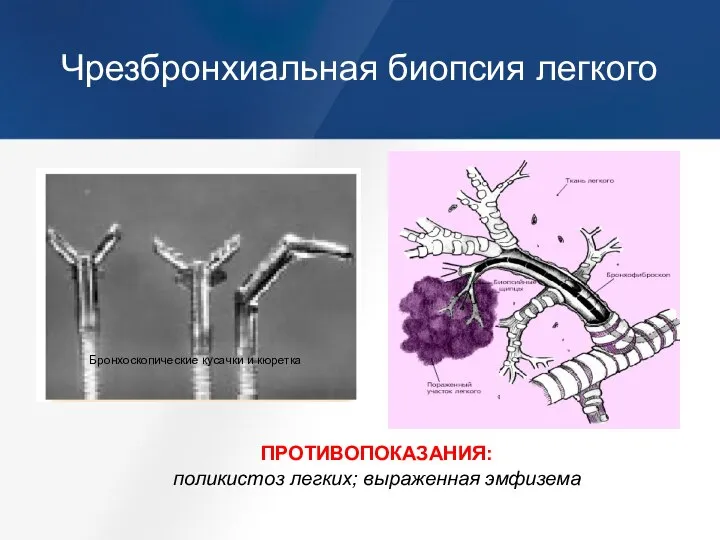 Чрезбронхиальная биопсия легкого ПРОТИВОПОКАЗАНИЯ: поликистоз легких; выраженная эмфизема Бронхоскопические кусачки и кюретка