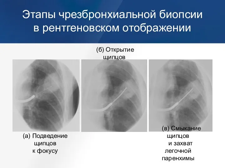 Этапы чрезбронхиальной биопсии в рентгеновском отображении (б) Открытие щипцов (в) Смыкание щипцов