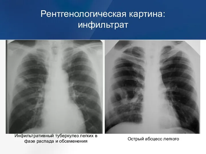 Рентгенологическая картина: инфильтрат Инфильтративный туберкулез легких в фазе распада и обсеменения Острый абсцесс легкого