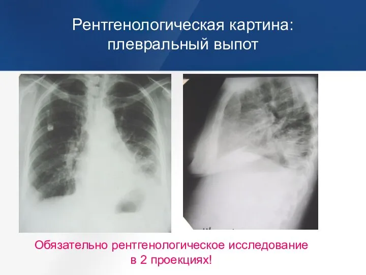 Рентгенологическая картина: плевральный выпот Обязательно рентгенологическое исследование в 2 проекциях!