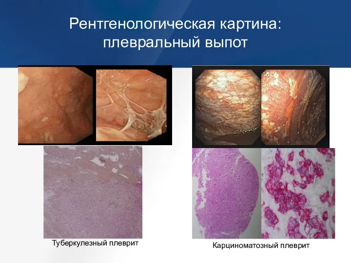 Рентгенологическая картина: плевральный выпот Туберкулезный плеврит Карциноматозный плеврит