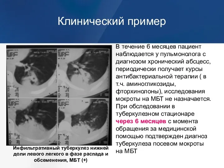 Клинический пример Инфильтративный туберкулез нижней доли левого легкого в фазе распада и