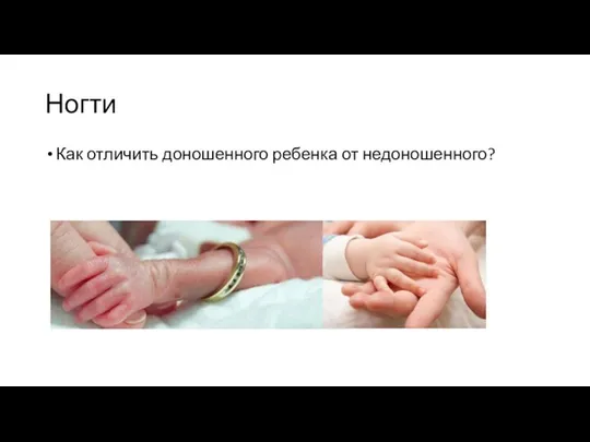 Ногти Как отличить доношенного ребенка от недоношенного?