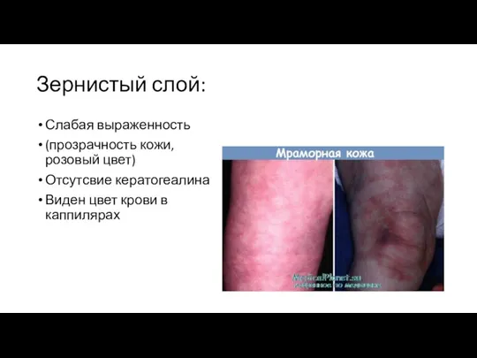 Зернистый слой: Слабая выраженность (прозрачность кожи, розовый цвет) Отсутсвие кератогеалина Виден цвет крови в каппилярах