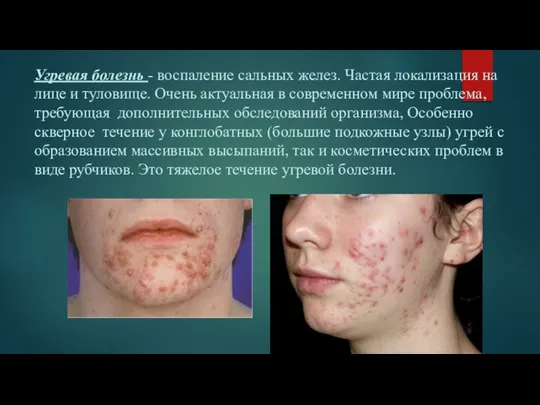 Угревая болезнь - воспаление сальных желез. Частая локализация на лице и туловище.