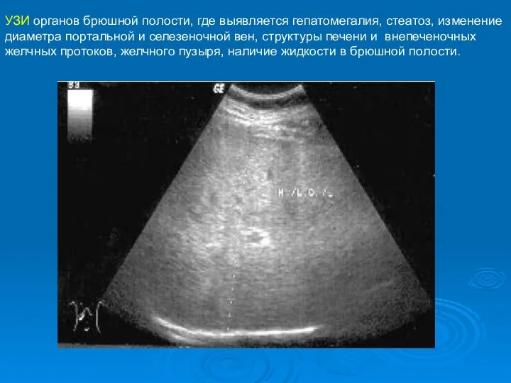 УЗИ органов брюшной полости, где выявляется гепатомегалия, стеатоз, изменение диаметра портальной и