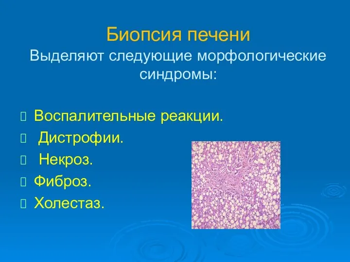Биопсия печени Выделяют следующие морфологические синдромы: Воспалительные реакции. Дистрофии. Некроз. Фиброз. Холестаз.
